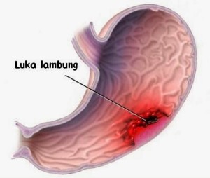 luka lambung kronis