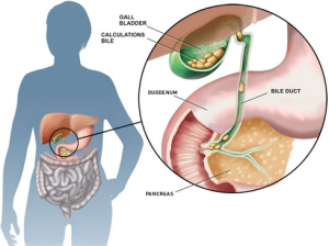 radang empedu pada anak