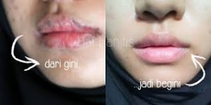 bibir pecah