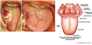 tumor lidah