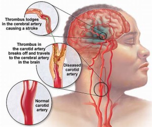 stroke akut