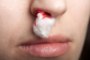 Wound nosebleed - adult human nose injury blood