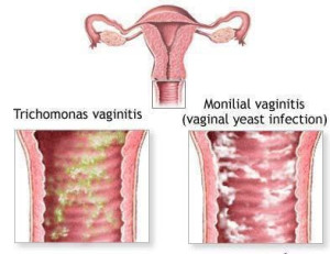 obat infeksi vagina pada ibu hamil