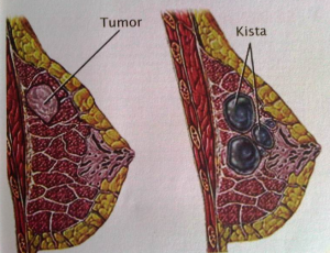 kista-payudara